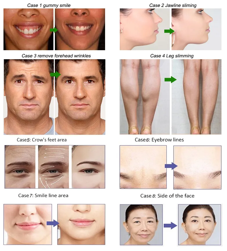Menurunkan Berat Badan Anti Kerutan Beutox Batulaxs Resty Filler Dermal Juvederms 1